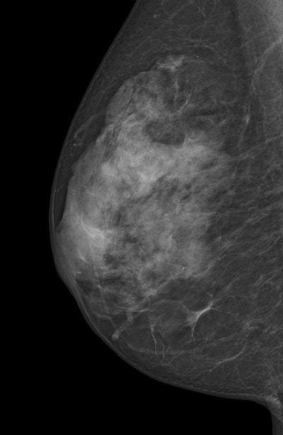 Digital mammogram of an ACR 3 dense breast. All images courtesy of Dr. Stefanie Weigel.