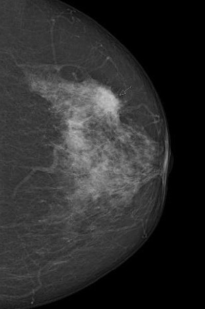 Digital screening mammogram of a 50-year-old woman taking part in the program for the first time. The patient had not noticed the relatively superficial tumor, which was at an advanced stage.