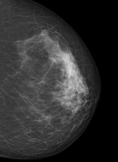 Digital screening mammogram of a 50-year-old woman taking part in the program for the first time. An invasive carcinoma was found, with precancerous microcalcifications nearby. The tumor was at an early stage. All images courtesy of Dr. Walter Heindel and the DRG.