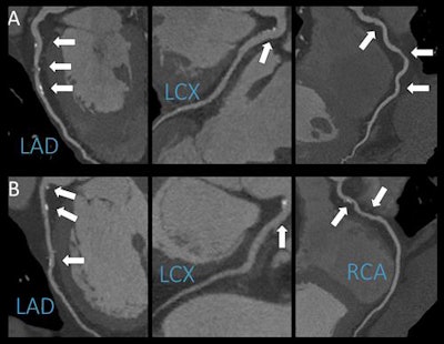 CCTA of a patient who reported no alcohol consumption (panel A) and of a patient who reported moderate alcohol consumption (panel B). The age- and gender-matched patients display the same extent and severity of coronary artery disease. Image courtesy of RSNA.