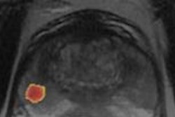 2016 11 30 16 56 16 190 2016 12 01 Mri Prostate Cad Thumb