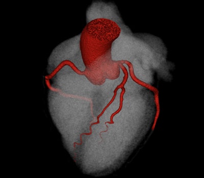 A 49-year-old woman with a personal history of hypertension, hypercholesterolemia, and an immediate family history of premature death due to ischemic heart disease was reviewed at a cardiology clinic in December 2015 with recurrent typical chest pain related to exertion and stress. An exercise tolerance test was stopped after five minutes due to dyspnea and elicited no chest pain but did demonstrate exercise-related left bundle branch block. CCTA in April 2016 demonstrated no evidence of coronary artery disease. Top: 3D reconstruction overview of the coronary arteries. Below: Normal LAD. Center: Normal left circumflex artery (LCx). Final image: Normal right coronary artery (RCA).