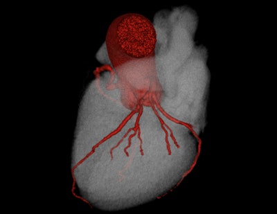 A 68-year-old man with a history of hypertension was reviewed at a rapid access chest pain clinic in January 2016 with atypical nonexertional central chest pain. An exercise tolerance test lasting under seven minutes elicited no chest pain but did demonstrate inferolateral ST depression. CCTA performed in March 2016 demonstrated severe stenosis in the proximal left anterior descending artery (LAD) due to a 10 mm long segment of mixed morphology plaque. The patient underwent elective percutaneous cardiac intervention in May with catheter angiography confirming 90% stenosis in the proximal LAD, which was treated with a drug-eluting stent with a satisfactory angiographic result. The patient made a good recovery, and on clinical review in June 2016, he reported having more energy with no recurrence of cardiac symptoms. Top: 3D reconstruction overview of the coronary arteries. Below: LAD lesion due to mixed morphology plaque, causing severe stenosis, shown on CCTA. Final image left: Catheter angiography confirming 90% stenosis in the LAD. Final image right: Catheter angiography after stent showing good result. All images courtesy of Dr. John G. Dreisbach.