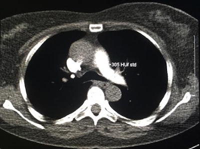 Above: Axial CT image of the midthorax from a CTPA monitoring scan (bolus-tracking 80-kV technique). The region of interest is centered over the pulmonary trunk and measures 305 Hounsfield units, which is sufficiently high to trigger the diagnostic scan. Below: A scout topogram from the same CTPA study. The transverse line illustrates the level at which the monitoring scan was performed and demonstrates that repeated scanning at this level would increase breast organ dose. All images courtesy of Dr. David P. Mitchell.