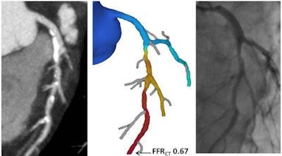 Fractional flow result of 0.67 (center) based on computational fluid dynamics reveals hemodynamically significant lesions requiring revascularization.