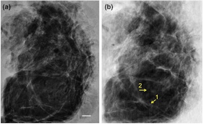 A 4-cm-thick breast tissue sample was imaged with conventional mammography (left) and using XPCI at the ESRF in Grenoble (right). The images show a similar level of detail, but corresponded to dramatically different mean glandular doses of 3.5 mGy and 0.12 mGy, respectively.