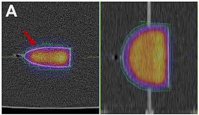 SPECT/CT reconstructions and volumes of interest were used to determine calibration factors for the adult kidney filled with lutetium-177 (A) and the corresponding sphere filled with iodine-131 (B).
