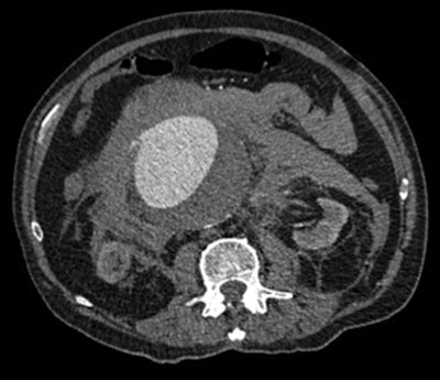 An example of a CT image of a leaking abdominal aortic aneurysm. Image courtesy of Dr. David Howlett.