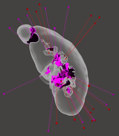Results of mesh error analysis in a kidney model being prepared for 3D printing show a large error at the intersection of a renal cell carcinoma and the upper pole of the kidney (pink region in top left). Thus, if an automated STL repair algorithm is used to repair this region, the intrarenal portion of the tumor will be erased. To avoid creating a significantly inaccurate model, this section of the model must be manually repaired. Image courtesy of Dr. Anish Ghodadra.