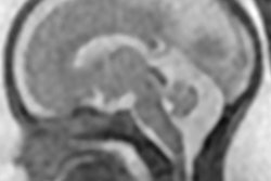 2016 12 14 13 13 36 943 2016 12 14 Fetal Mri Thumb
