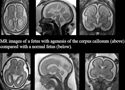 Fetal MR images of the normal brain compared with those showing an abnormality. Images courtesy of Cara Mooney.
