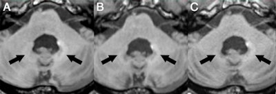 Axial MR images of a patient before (A) and after nine (B), 17 (C), 29 (D), and 41 (E) administrations of gadobutrol and gadoterate meglumine. Pre-existing hyperintensities in the dentate nucleus (most likely related to prior linear GBCA injection) are visible in all images. There is a slight decrease in hyperintensities between the baseline MRI and the MRI after 41 injections of macrocyclic GBCAs. Images courtesy of Radiology.