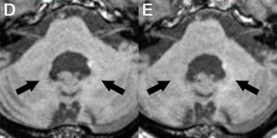 Axial MRI of patient receiving GBCAs