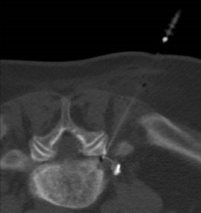 CT-guided periradicular therapy can treat chronic pain caused by degenerative diseases of the spine. Image courtesy of Dr. Kai Wilhelm, Chefarzt Radiologie Johanniter Krankenhaus Bonn.