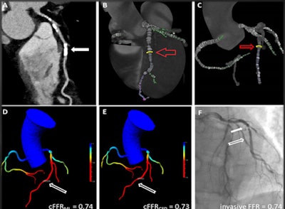 In a 53-year-old man with chest pain, both CCTA and invasive coronary angiography showed 50% stenosis of the middle left anterior descending (LAD) artery, while cFFRML and cFFRCFD showed a greater degree of stenosis, at 74% and 73%, respectively. Image courtesy of Dr. Moritz Albrecht.