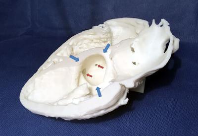 3D-printed heart, cut out to create a four-chamber axis showing an inferoseptobasal aneurysm (blue arrows) with two small ventricular septal defects (red arrows).