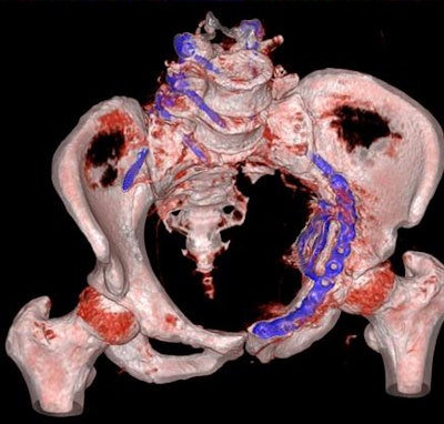 Postoperative CT scan showing the implanted plate.