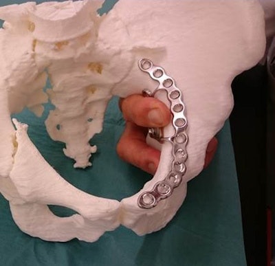 Above: Preoperative modeling of the osteosynthesis plate to reduce operating room time and ensure an optimal fit. Below: Intraoperative view.