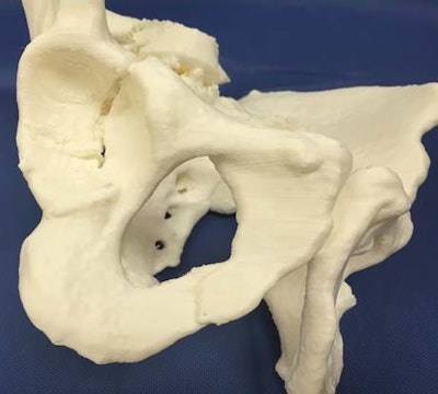3D-print of a complex acetabular fracture, the nonfractured side was mirrored over to the fractured side. All images courtesy of Dr. Philipp Brantner.