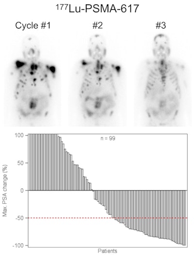 Lutetium-177 PSMA-617 radionuclide therapy has been shown to reduce tumor burden and induce prostate-specific antigen remission in patients with metastatic advanced prostate cancer. Image courtesy of JNM.