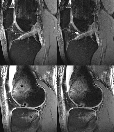 The use of simultaneous multislice imaging for abbreviated scan times in a trauma patient (motorcycle accident). A ruptured anterior cruciate ligament (arrow) is seen on (top row) sagittal proton density-weighted images acquired at 3-tesla, together with (bottom row) bone marrow edema (asterisk) of the distal femur, lateral femoral condyle, and posterolateral tibial plateau. Depiction is essentially equivalent on the scans without and with simultaneous multislice imaging. The simultaneous multislice imaging scan, due to use of two times acceleration, required only 1:34 min:s for acquisition, approximately half that for the nonsimultaneous multislice imaging scan. All images courtesy of Investigative Radiology (January 2017, vol. 52:1, pp. 1-17).
