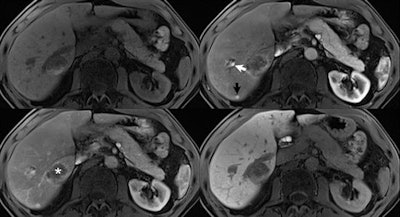 Application of an ultrashort breath-hold Dixon VIBE sequence for improved arterial phase imaging, with resultant overall improved image quality due to better patient compliance. Precontrast (top left), first (top right), and third (bottom left) arterial phase images, and 20-minute delayed hepatocellular phase images (bottom right) after injection of gadoxetic acid are presented in a 74-year-old man with metastatic rectal adenocarcinoma. Acquisition time for each image series was 4.8 seconds, with scans acquired at 3-tesla using a 60-channel body coil. A new small metastasis along the dorsal margin of the liver (black arrow) demonstrates prominent early arterial enhancement, with some wash out by the late arterial image, and no uptake in the delayed phase. Also visualized at this level are a hemangioma (white arrow) and a larger metastasis previously treated by microwave ablation (asterisk). Note the absence of respiratory artifacts due primarily to the short scan time, as compared with more conventional 15 to 20 seconds VIBE acquisitions.