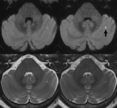 The use of simultaneous multislice imaging to decrease scan time for thin section imaging of the brain. A small pinpoint early subacute cerebellar infarct (arrow) is seen, on images acquired at 3-tesla using a 64-channel head and neck coil, in a 49-year-old female patient. For all scans, 2.5-mm-thick sections were acquired through the entire brain. Readout-segmented, diffusion-weighted (b = 1,000) images are compared in the upper row, without and with simultaneous multislice imaging (two times acceleration). simultaneous multislice imaging was used to allow a decrease in TR from 12.75 to 6.38 seconds, with scan time thus decreasing from 5:46 to 3:26min:s. In the lower row, T2-weighted scans without and with simultaneous multislice imaging (three times acceleration) are compared. In this instance, simultaneous multislice imaging was used to eliminate the need for concatenations (three were required for the conventional scan, due to the number of slices), resulting in a decrease in scan time from 1:29  3 (4:27) to 1:45 min:s.