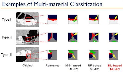 Multimaterial classification compares the ability of three machine learning techniques to correctly label colonic regions for CT colonography: k-nearest neighbor-based electronic cleansing, random forest classifier electronic cleansing (RF), and deep learning based electronic cleansing (DL-EC), also known as deep convolutional neural network (DNNC)-base electronic cleaning. All images courtesy of Dr. Hiroyuki Yoshida, PhD, Harvard School of Medicine.