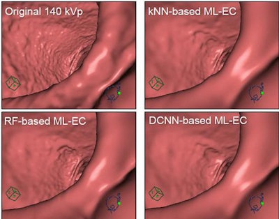 Three-dimensional visualization of colonic region using three electronic cleansing techniques and the reference standard shows that deep learning based electronic cleansing (DL-EC), also known as deep convolutional neural network (DNNC)-base electronic cleaning, does a better job of removing image artifacts.