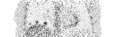 The animated images show the visual improvement achieved by including regularization within motion-compensated PET image reconstruction, for three lesions in a computational phantom. Original source: C Tsoumpas, Physics in Medicine and Biology, Vol. 58:6, pp. 1759-1773.