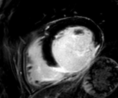 A 59- year-old man with acute myocardial infarction: late enhancement inferior and inferolateral, basal to apical, accompanied by a slight contrast substance enrichment of the pericardium.