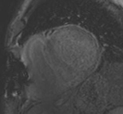 A 78-year-old man with cardiac amyloidosis: Nulling of 'normal' myocardium is impossible, typical for storage disease. A PET/CT scan confirmed the diagnosis.