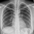 2017 01 20 12 40 52 84 2017 01 23 Refugee Chest Xray Afghani Thumb