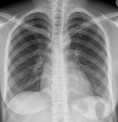 This CXR of a 26-year-old female Afghani refugee was normal at screening, but she was later diagnosed with pulmonary TB. Image courtesy of Dr. Julius Weinrich.