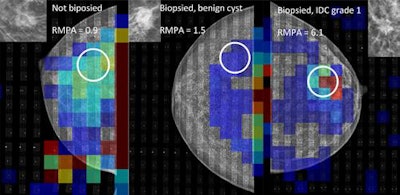 Examples of mechanical imaging data from the study, matched with corresponding mammogram. All three groups are represented, from left to right: A, not biopsied, presumed benign; B, biopsied, benign; and C, biopsied, malignant. Note the presence of a high-pressure area outside of the breast on the left-most image; it is caused by wrinkling of the sensor. This is one example of a technical problem, which in this case did not affect the measurement. All images courtesy of Magnus Dustler.
