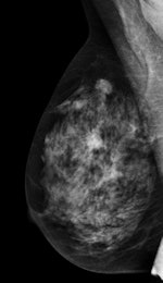 Mediolateral oblique view of a patient with two malignant masses (invasive ductal carcinomas) using mammography
