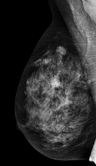 Mediolateral oblique view of a patient with two malignant masses (invasive ductal carcinomas) using mammography