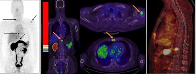 Ga-68 BBN-RGD PET/CT of a 64-year-old man with newly diagnosed prostate cancer shows multiple bone metastases (arrow). Image courtesy of JNM and Jingjing Zhang, Peking Union Medical College in Beijing.