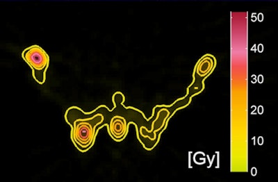 A transversal slice through the pelvis of a SPECT-based absorbed dose distribution of a patient with bone metastases treated with Re-186 HEDP.