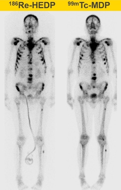 Whole-body therapeutic (Re-186 HEDP) and diagnostic (Tc-99m) bone scans of a patient with bone metastases. All images courtesy of Ana Denis-Bacelar.