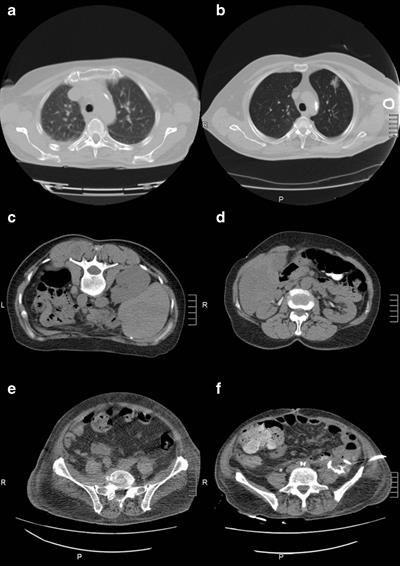 CT fluoroscopy with FBP (left) and AIDR 3D (right). Body regions were demonstrated in patients with comparable circumferences. Thoracic region: (a) in a patient (female, 73.7 years old, body circumference = 104 cm) for biopsy of a pulmonary lesion and (b) a patient (male, 70.4 years old, body circumference = 108 cm) for drainage placement. Abdominal region: (c) in a patient (female, 50.9 years old, body circumference = 84 cm) for biopsy of a lymph node and (d) a patient (female, 56.1 years old, body circumference = 88 cm) for biopsy of a liver lesion. Pelvic region: (e) in a patient (male, 69.3 years old, body circumference = 98 cm) for biopsy of a lymph node and (f) a patient (male 72.0 years old, body circumference = 94 cm) for drainage placement. All images courtesy of Dr. Oliver Grosser and European Radiology.