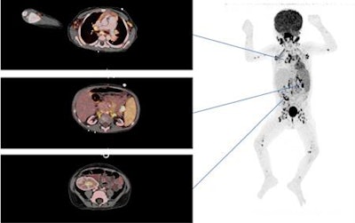 Above: An FDG-PET/CT scan of a 3-year-old kidney and liver recipient with fever shows increased FDG uptake in enlarged and normal-sized lymph nodes above and below diaphragm, including the extremities. Below: The patient was in complete remission after three weeks of treatment. The area with increased FDG retention in the right fossa corresponds to urine excretion in the well-functioning graft. Images courtesy of EJNMMI.