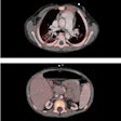 2017 02 16 17 13 30 755 Pet Ct Transplant Ejnmmi 20170217002429