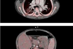 2017 02 16 17 13 30 755 Pet Ct Transplant Ejnmmi 20170217002429
