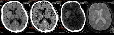 DECT can suggest only limited breakdown of the blood-brain barrier, while the MRI gradient echo reveals the true hemorrhage. A: virtual polychromatic CT. B: water-weighted. C: iodine-weighted. D: Gradient-echo sequence of MRI. Image courtesy of Dr. Leonard Yeo.