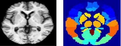 Above, MRI image (left), MRI atlas (right) used for deep learning-based image analysis. Below, PET image (left) and PET atlas (right). Images courtesy of Andrés Ortiz, PhD.