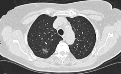 CT screening detected a part-solid ground-glass opacity nodule from the Danish Lung Cancer Screening Trial. Final diagnosis was adenocarcinoma. All images courtesy of Dr. Jesper Pedersen.