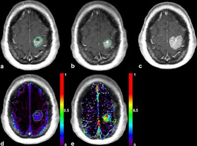 Patient with a left precentral metastasis on T1-weighted images at baseline (a), early follow-up (b), midterm follow-up (c), parametric map of extravascular extracellular space per unit volume of tissue at baseline (d), and midterm follow-up (e). A volumetric regression of the lesion was observed on the conventional T1-weighted sequence with gadolinium injection between baseline (a) and early follow-up (b). DCE-MRI parametric map demonstrated an increase of the extravascular extracellular space per unit volume of tissue value between baseline (d) and early follow-up (e), which predicted the volumetric progression of the lesion at midterm follow-up (c). The green dotted line represents the region of interest used for DCE-MRI measurement at baseline (a, d) and early follow-up (b, e), corresponding to the enhancing part of the lesion at the level of maximum section area with careful exclusion of necrotic components. Image courtesy of Dr. Grégory Kuchcinski and European Radiology.