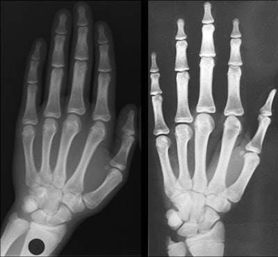 Bone age evaluations raise complex issues | AuntMinnieEurope