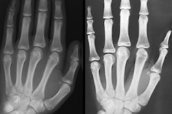 2017 02 28 17 06 03 847 2017 03 01 Age Hand X Rays Thumb
